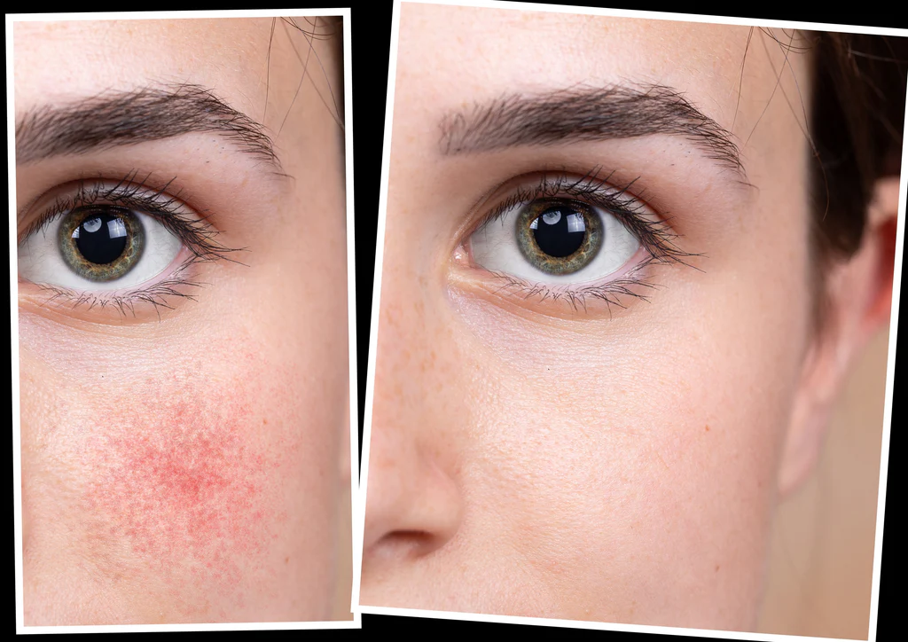 The best Skincare for Rosacea